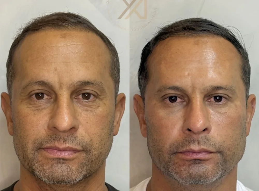 Antes e depois, vista frontal