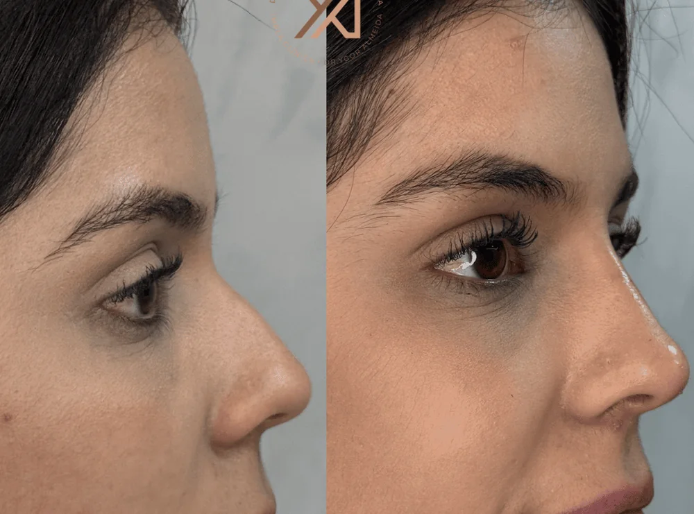 Antes e depois, vista de perfil