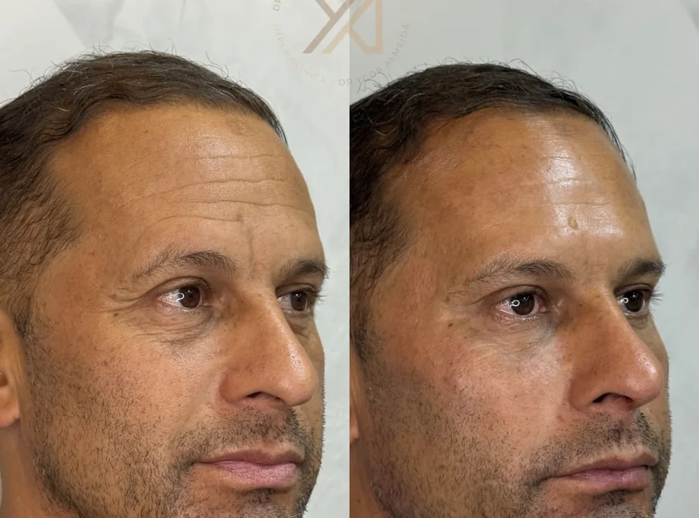 Antes e depois, vista em três quartos