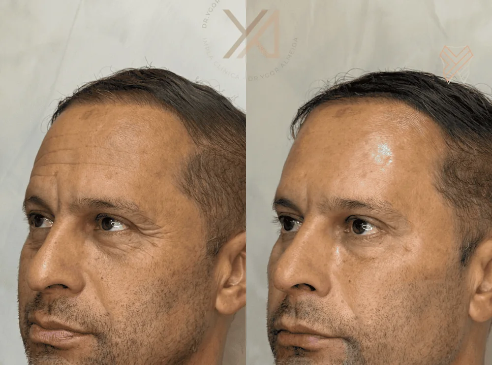 Antes e depois, vista lateral