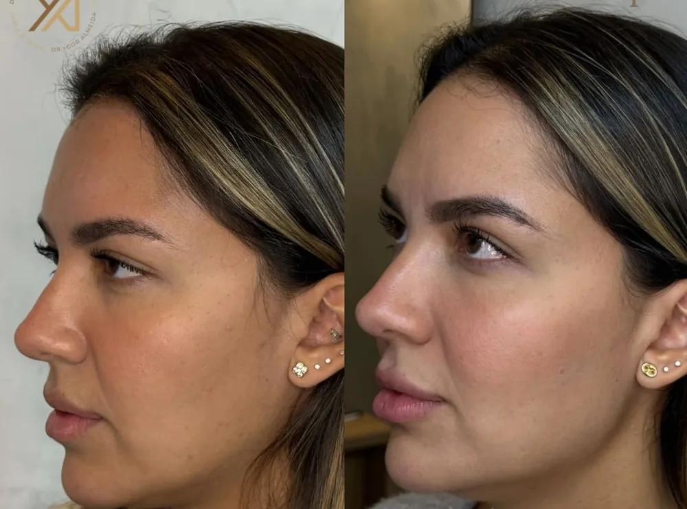 Antes e depois, vista de perfil